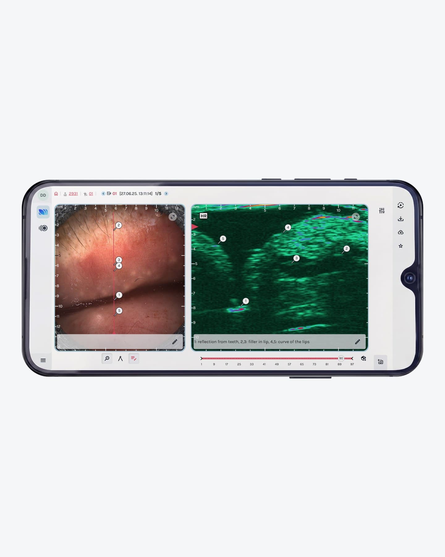 SkinAid: filler depth measured on the ultrasound image