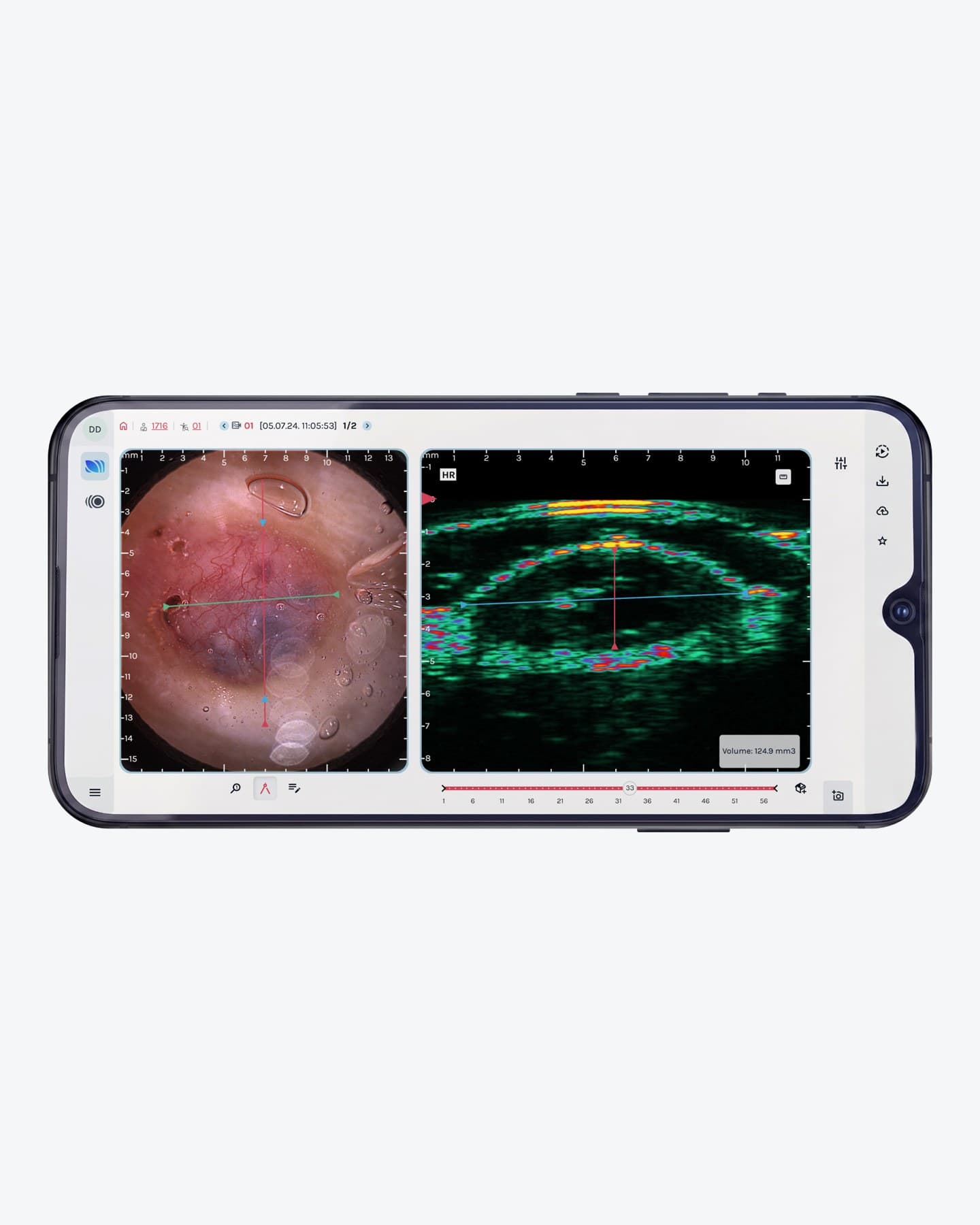 SkinAid: dermoscopy and ultrasound side by side