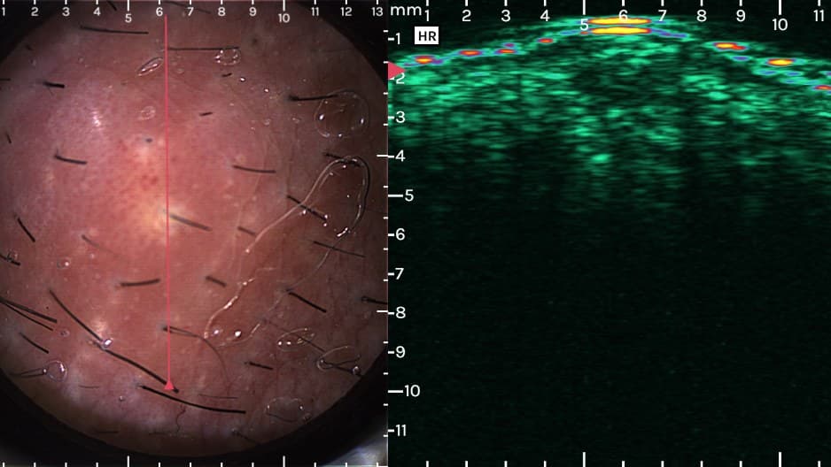 Acne: inflammatory lesions below the surface