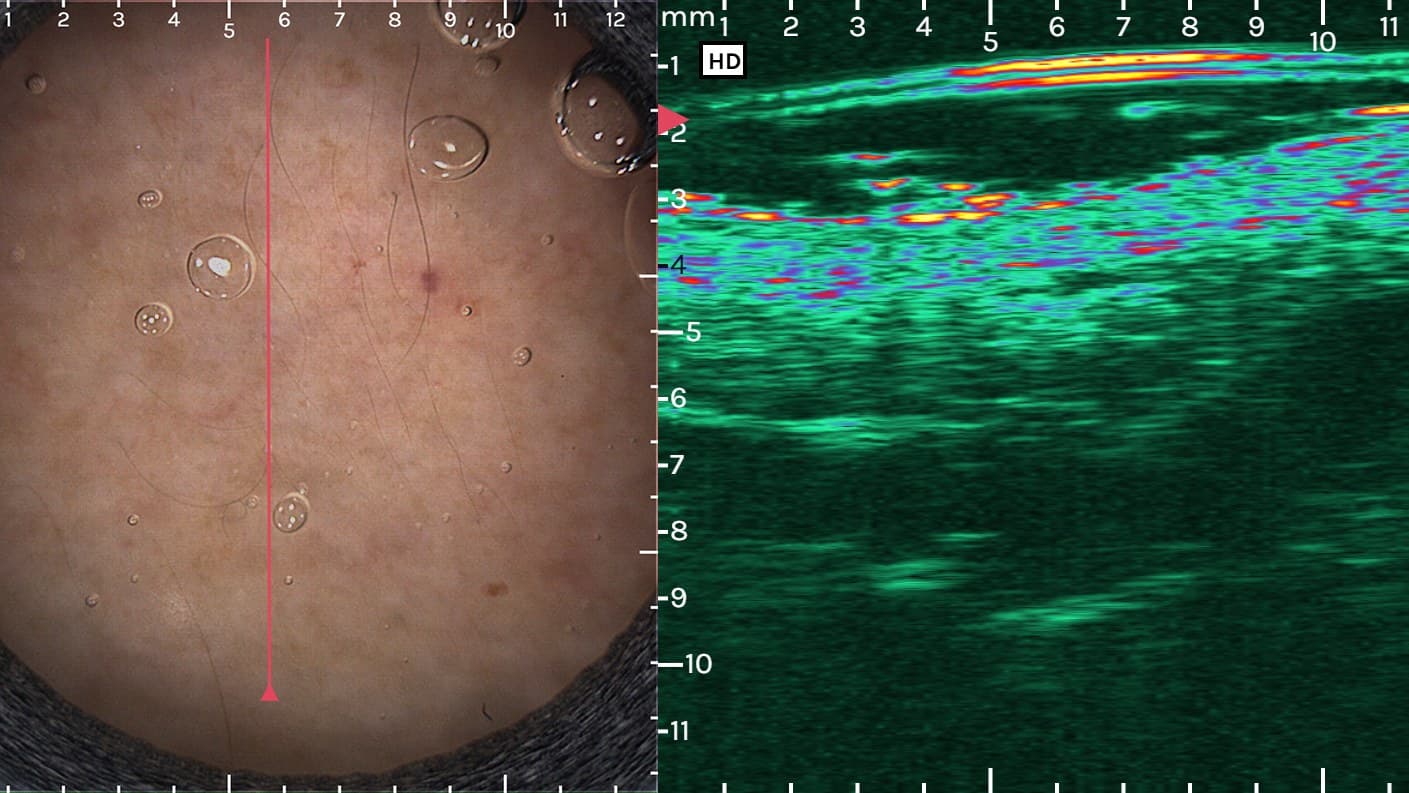 Dermal filler: dermoscopy and ultrasound show the filler deposit and its depth