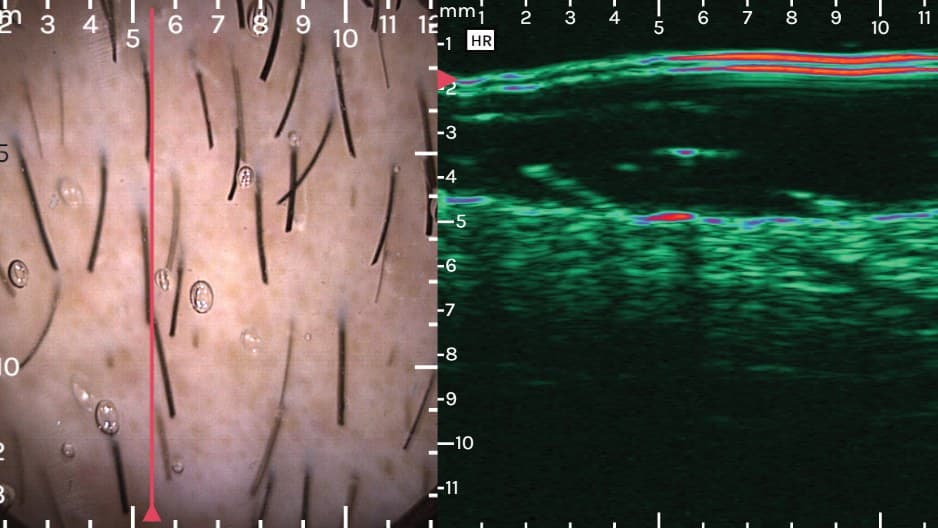 Hair and scalp: follicle depth and density