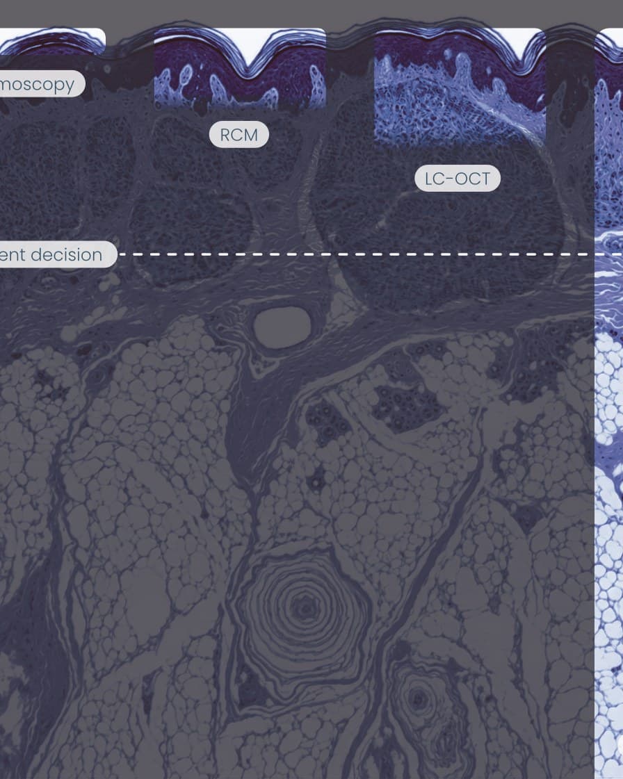 Imaging depth of dermoscopy, RCM, LC-OCT and dermatological high-frequency ultrasound