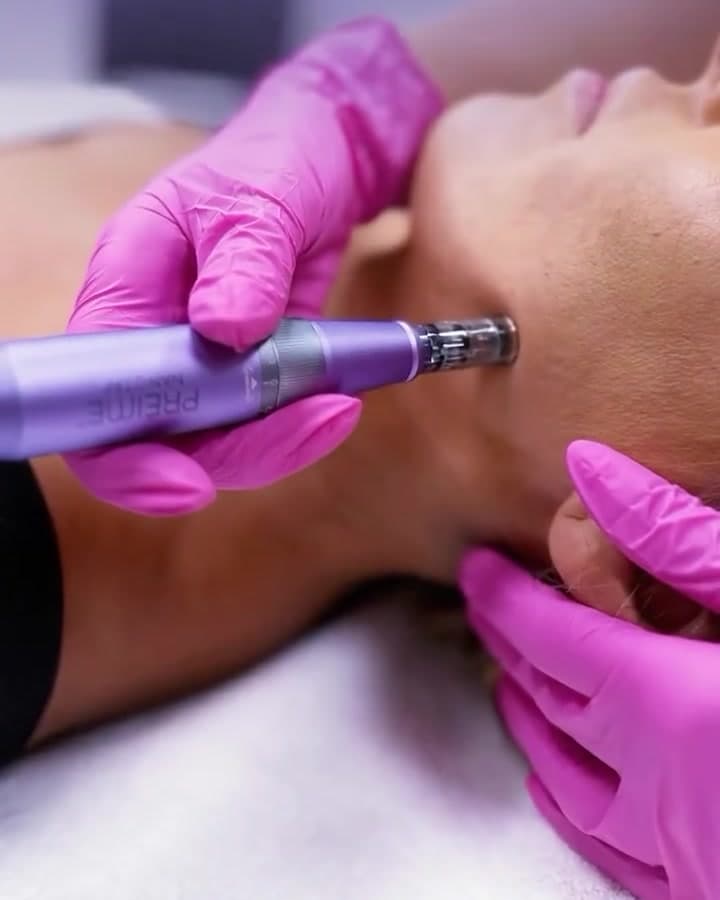 NanoTap Pen in treatment