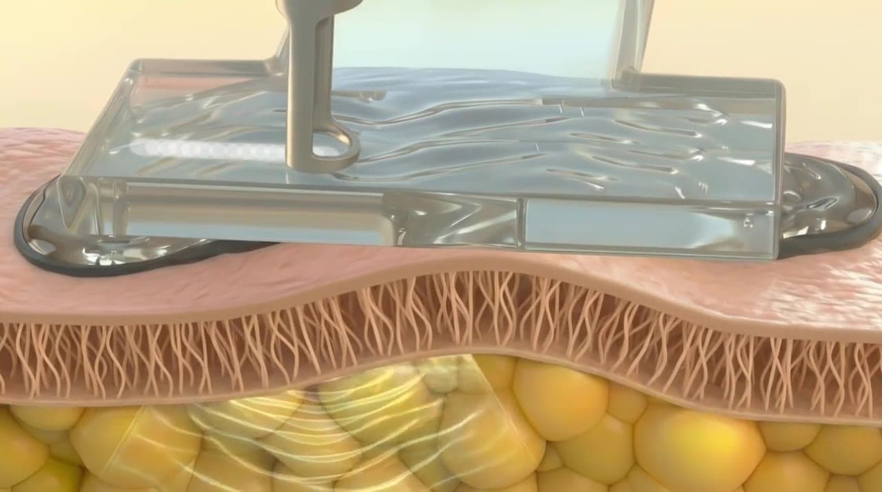 The patch and lens on the skin — from the manufacturer's animation